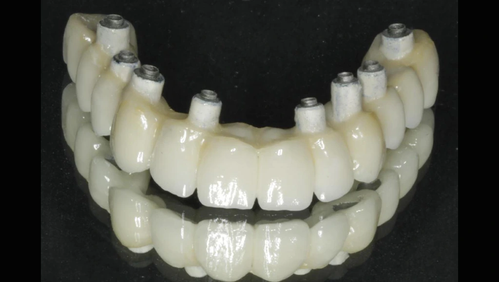 Prótesis fija sobre implantes